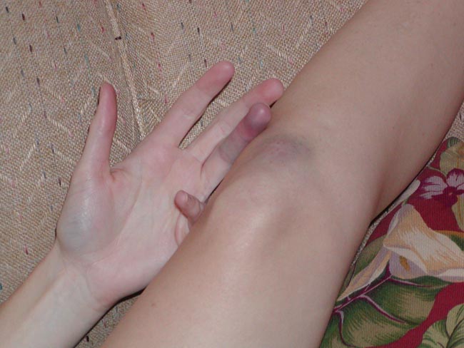 dec 05 flag football bruises